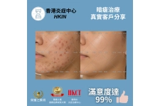 香港炎症中心_真實客戶分享_暗瘡治療2_的複本