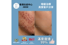 香港炎症中心_真實客戶分享_暗瘡治療3
