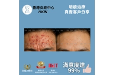 香港炎症中心_真實客戶分享_暗瘡治療4_的複本_的複本