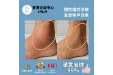 香港炎症中心_真實客戶分享_痛症治療腳踝