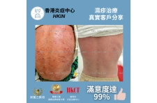 香港炎症中心_真實客戶分享_濕疹治療4