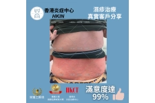 香港炎症中心_真實客戶分享_濕疹治療6_(1)