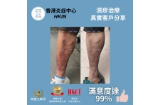 香港炎症中心_真實客戶分享_濕疹治療